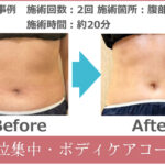 部位・ボディケアコース